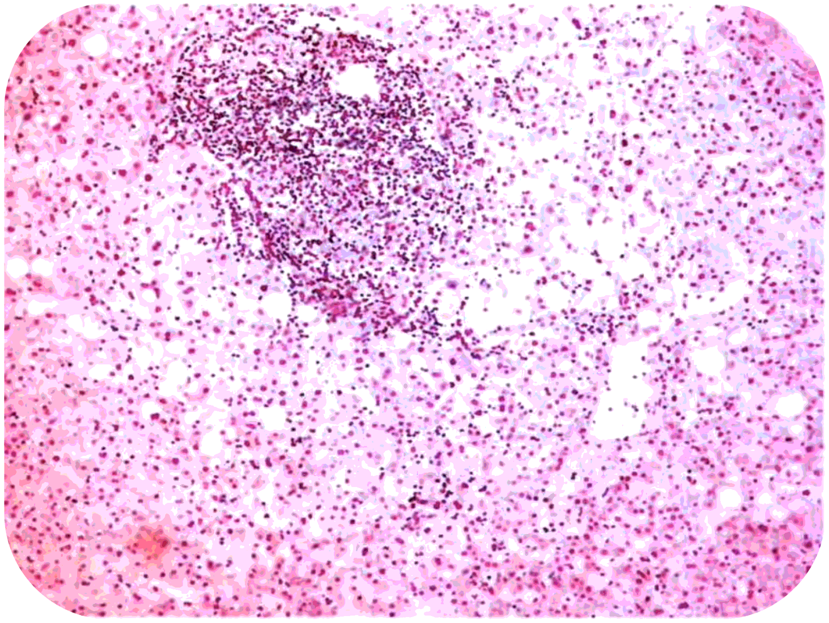 Cливные некрозы геnатоцитов 