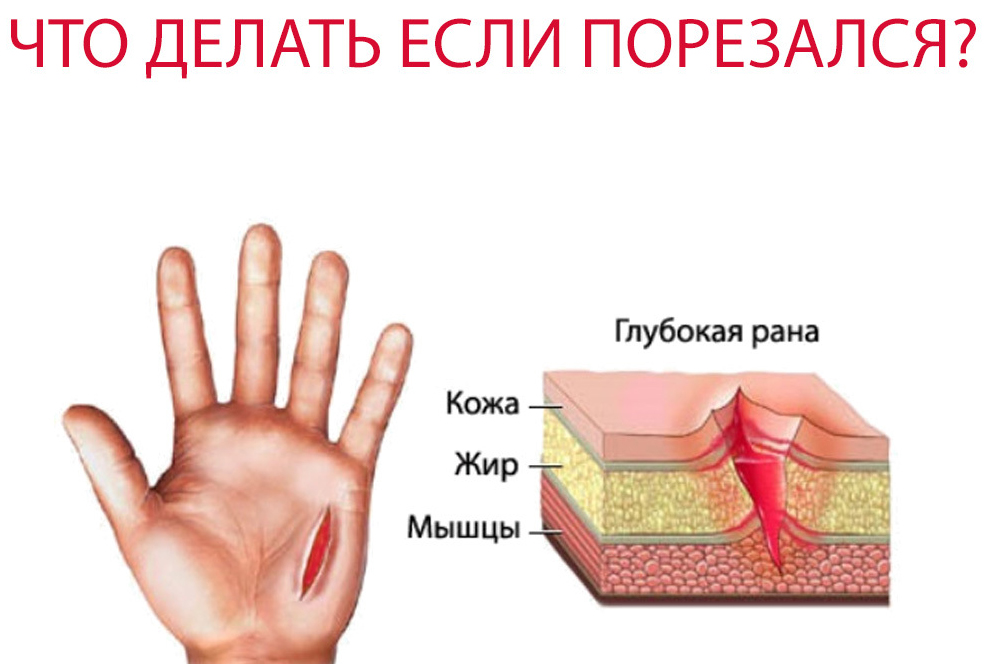 Наложение повязки на рану