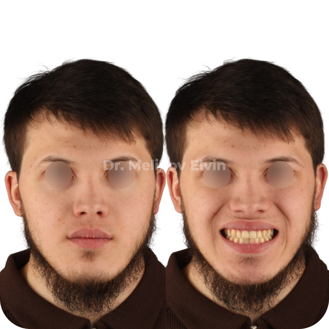 Фотографии до и после ортогнатической операции.