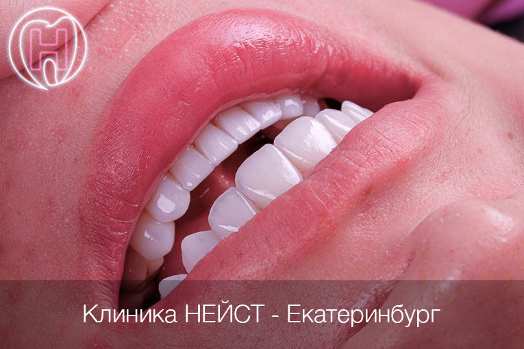 керамические виниры цвет Блич 2 (Bleach2)