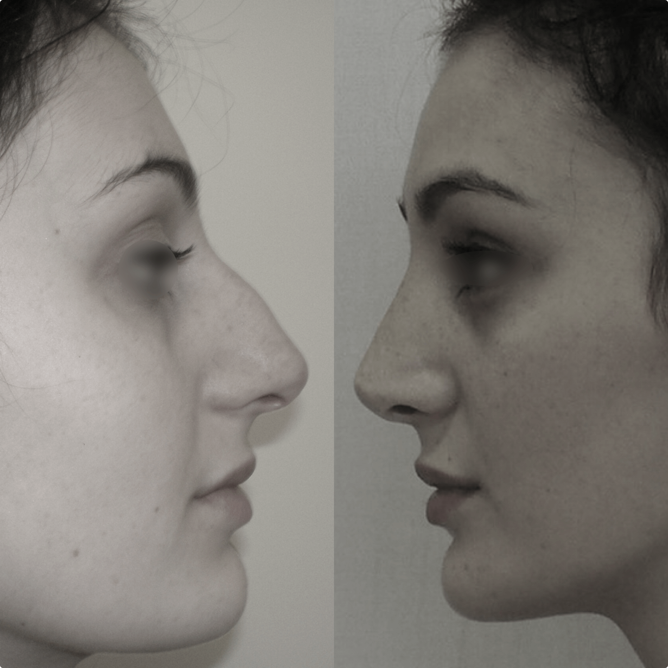 Belo rhinoplasty