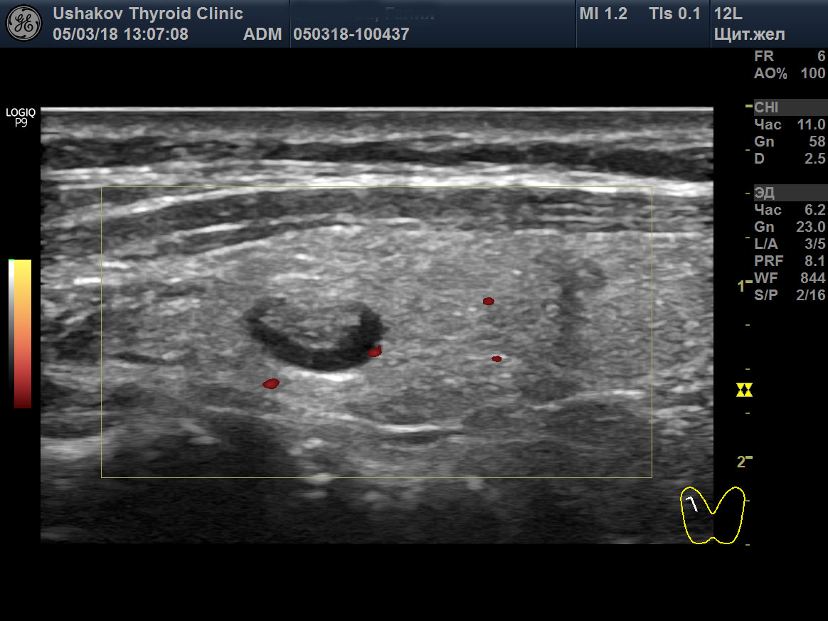 Тирадс 4 щитовидной железы. Щитовидная железа УЗИ ti-rads. УЗИ щитовидной железы ti-rads-3. УЗИ щитовидки ti rads 1. Ti-rads 3 щитовидной железы что это.