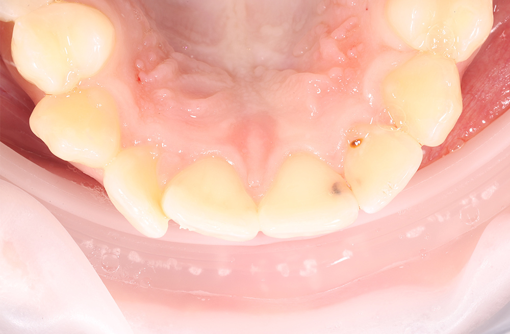 Лечение контактного кариеса передних зубов