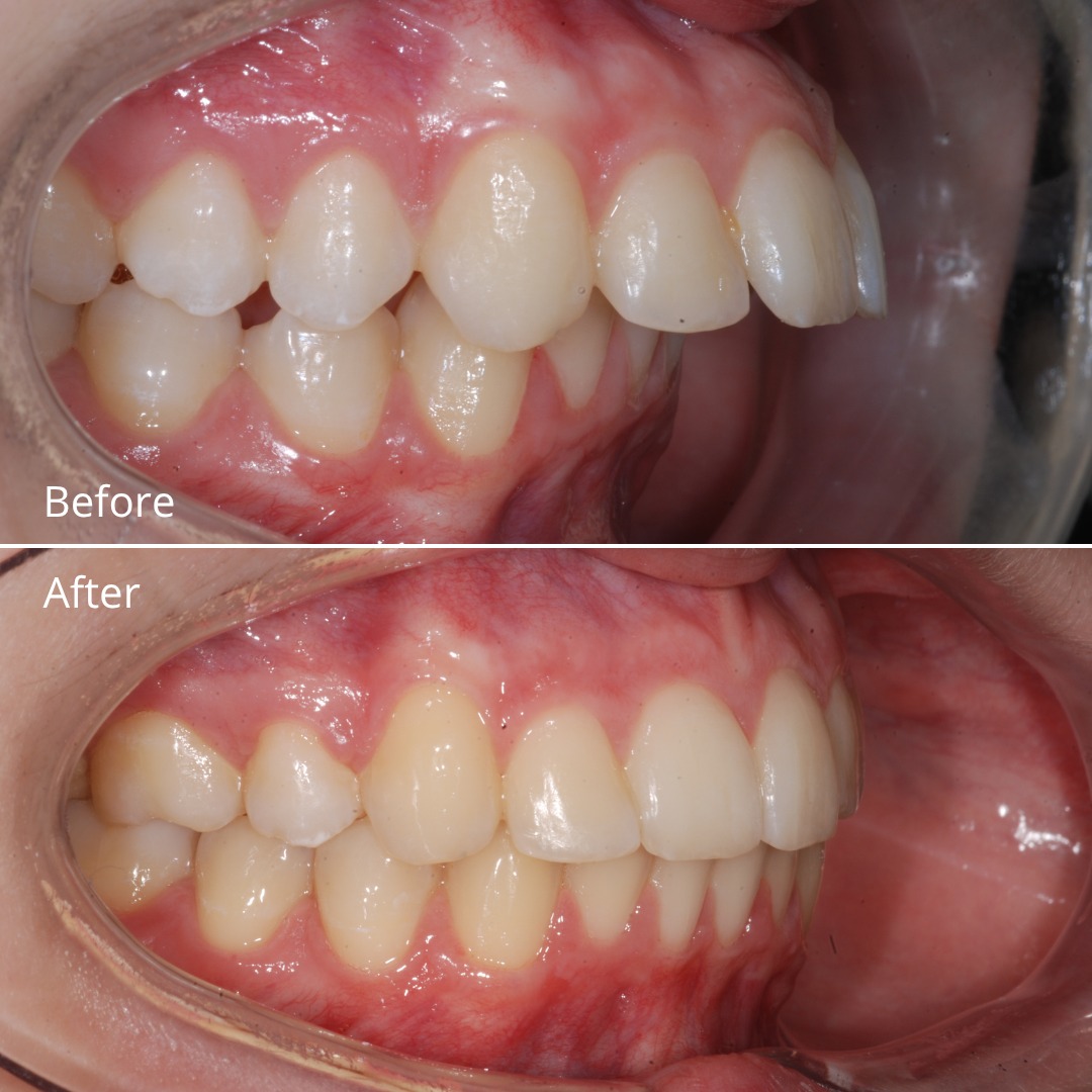Stage showing the profile improving as protrusion resolves — photo 4 of 6