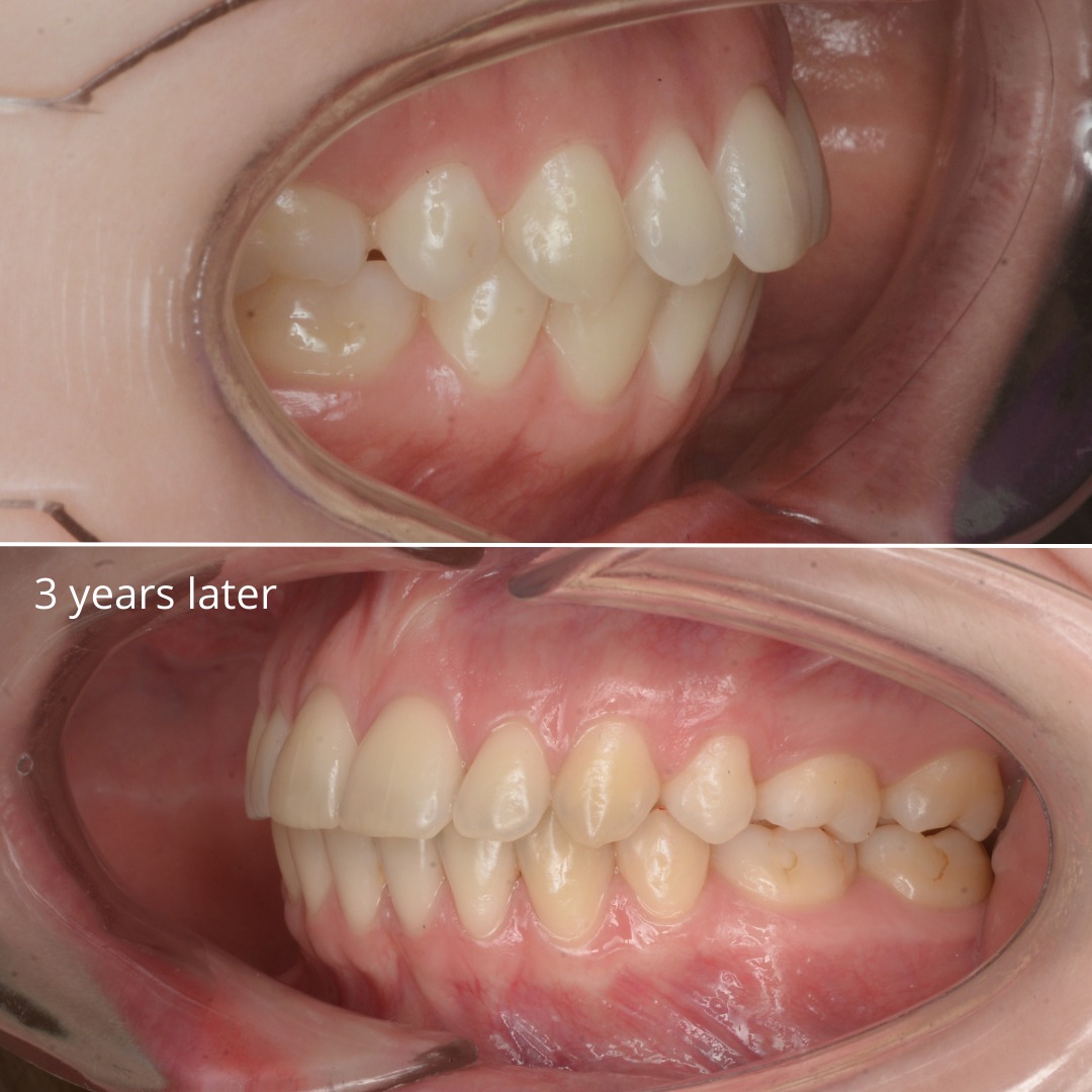 Stage shortly before debonding, showing corrected alignment — photo 6 of 7