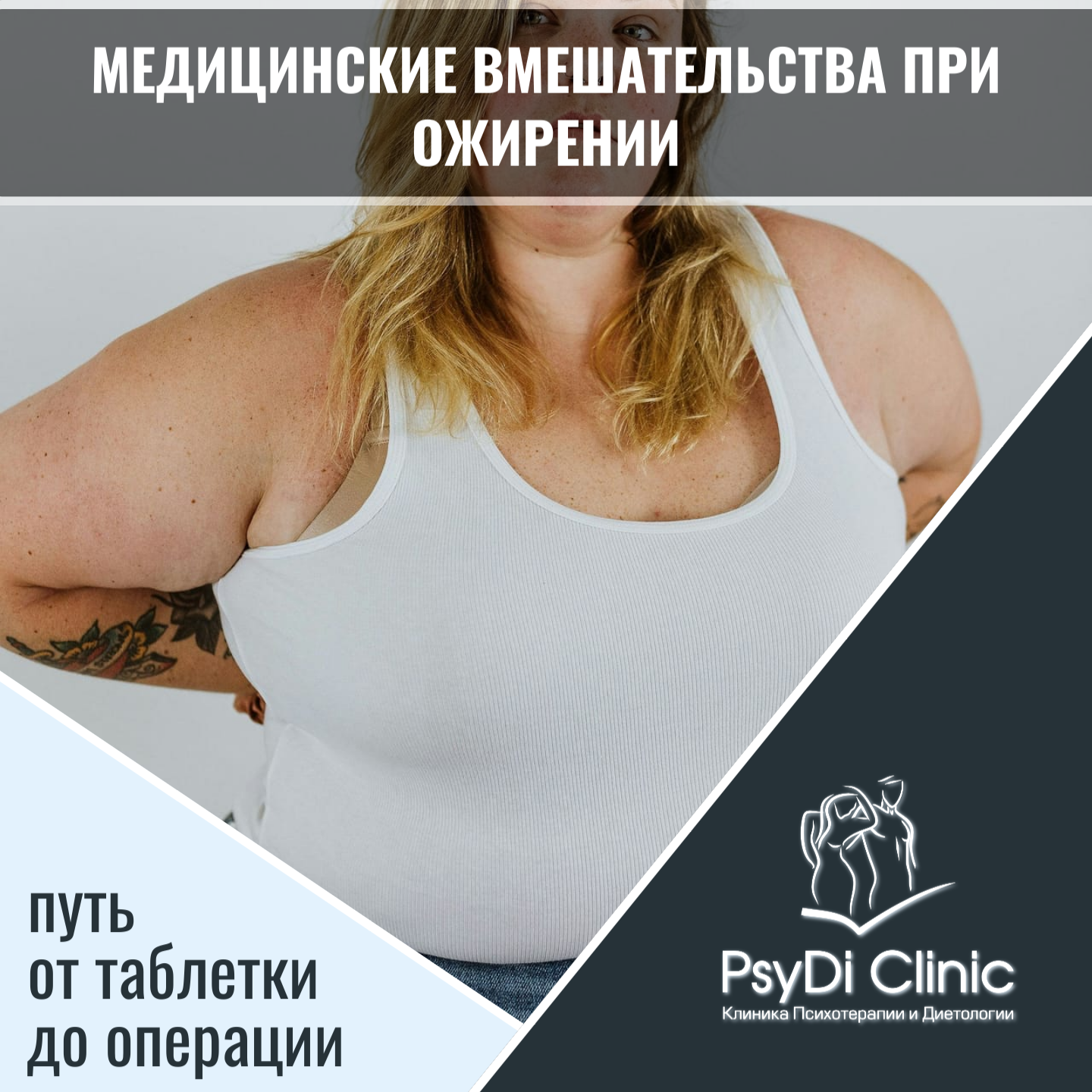 Медицинские вмешательства при ожирении: путь от таблетки до операции