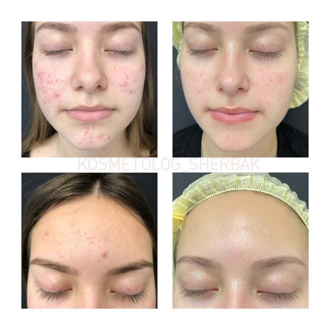 Лечение акне у женщины в клинике PradusCOSMO, СПб. До и после процедуры