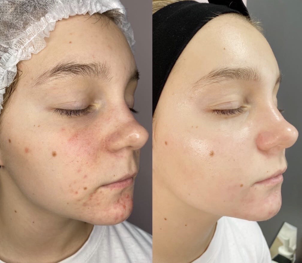 Отличия системы клеточного омоложения кожи HELEO 4 от других методов светолечени