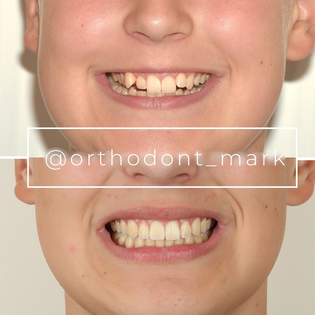 Maxillary Narrowing and Canine Supraposition Corrected