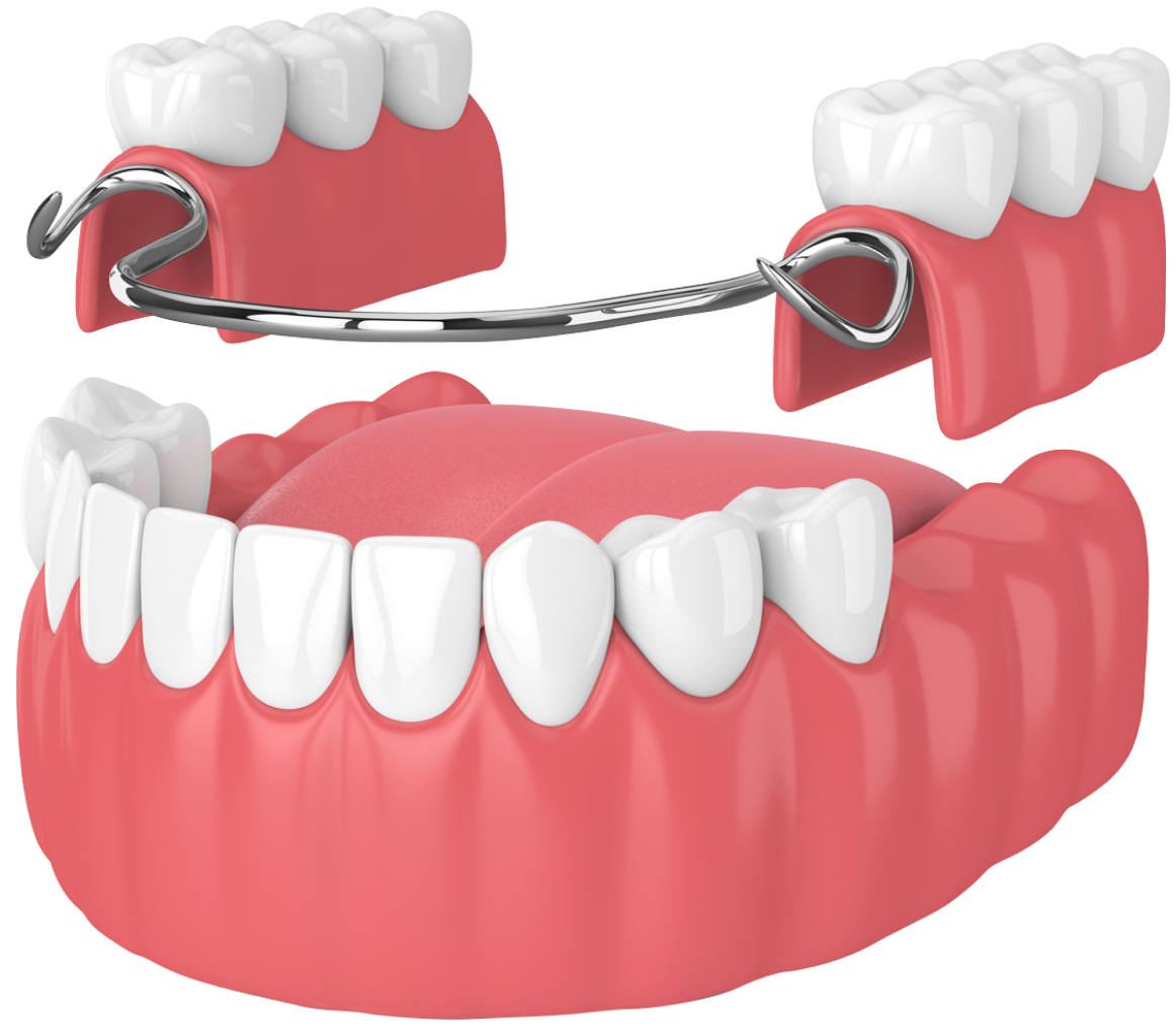 Протезирование зубов инвалидам 3 группы. Несъемные зубные протезы.