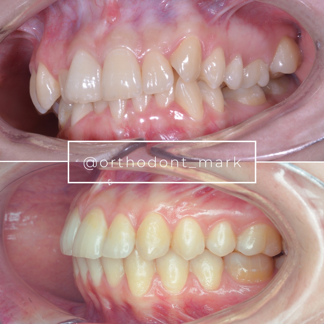 Stage showing the scissor bite improving at the posterior segment — photo 4 of 6