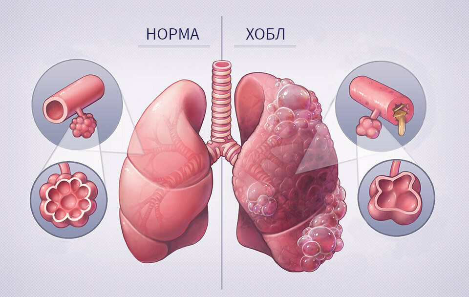 Легкие при хобл картинки