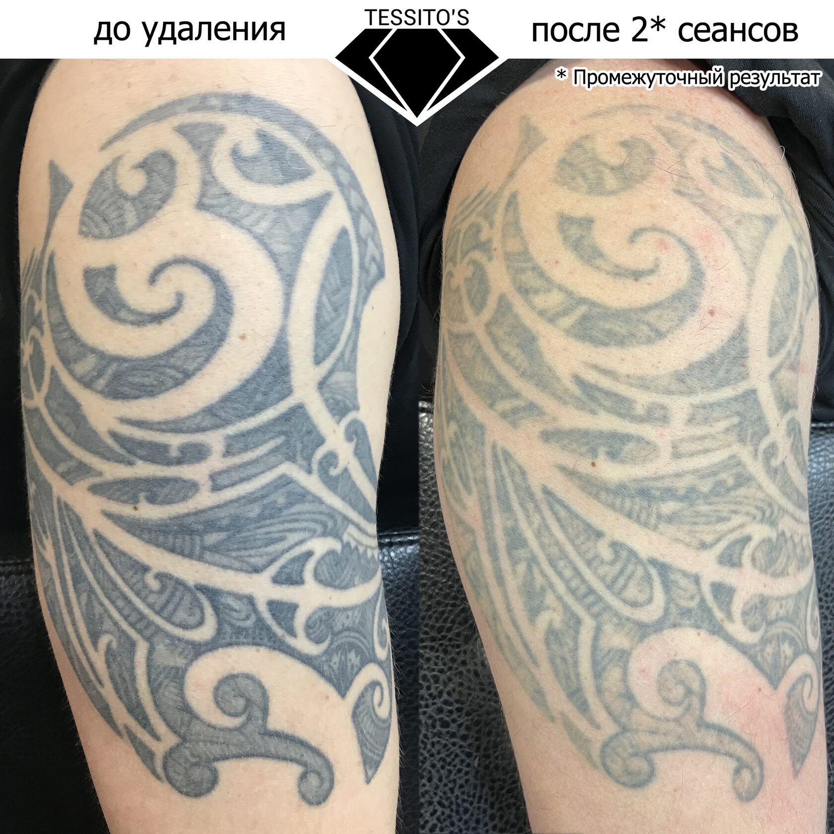 Удаление татуировок в Санкт-Петербурге — 52 специалиста, 15 отзывов на Профи