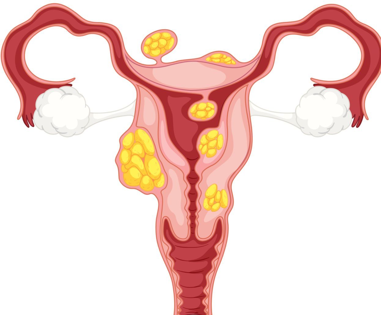 Миома матки