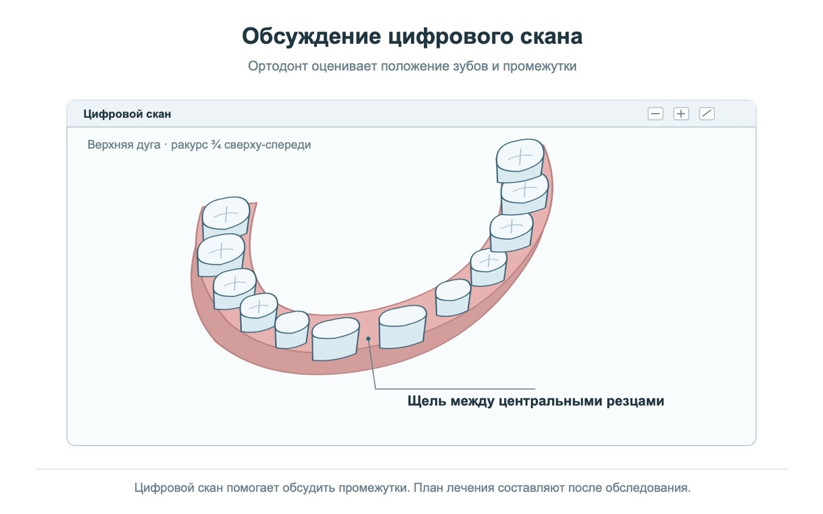 Цифровой скан зубного ряда: щель между центральными резцами
