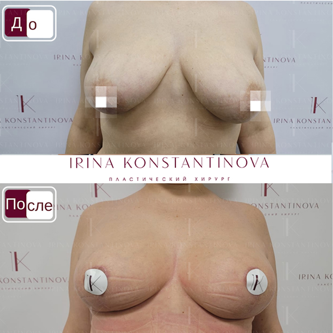операция по подтяжке груди у женщин фото 107