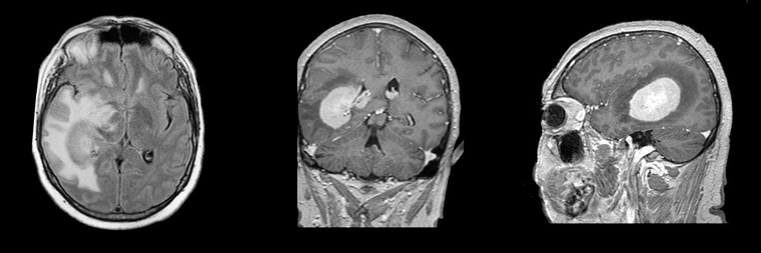 Первичная лимфома ЦНС - Диагностика и лечение