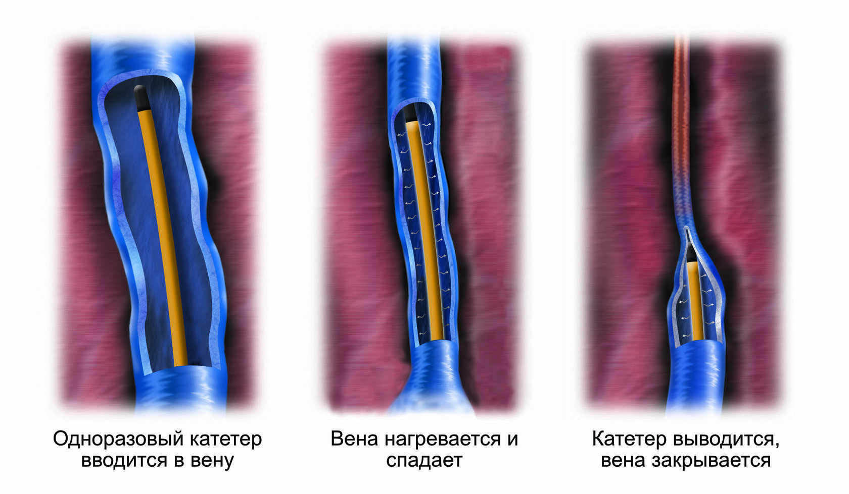 РАДИОЧАСТОТНАЯ АБЛЯЦИЯ ВЕН — цены в Санкт-Петербурге, отзывы, фото ДО ПОСЛЕ  радиочастотной абляции