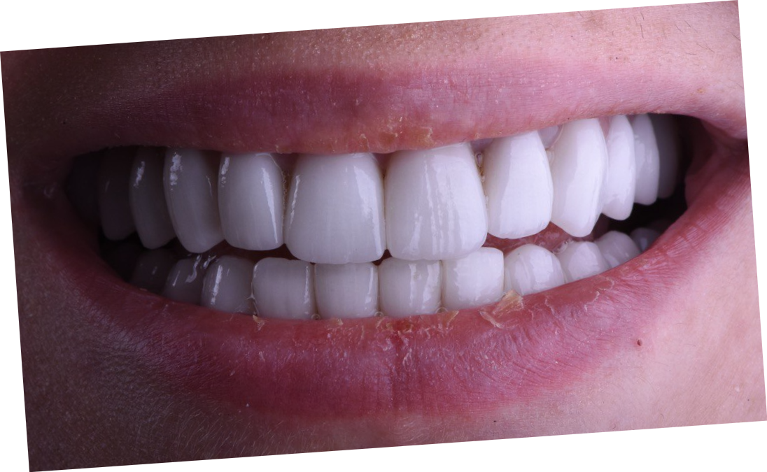 Протезирование