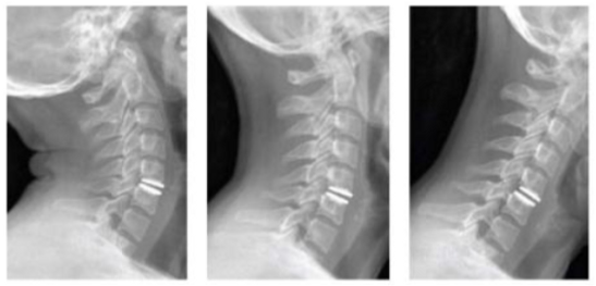 Операция на шейном отделе. Имплант диска шейного отдела позвоночника. Дерецепция шейных позвонков. Операция на диск шейного отдела.