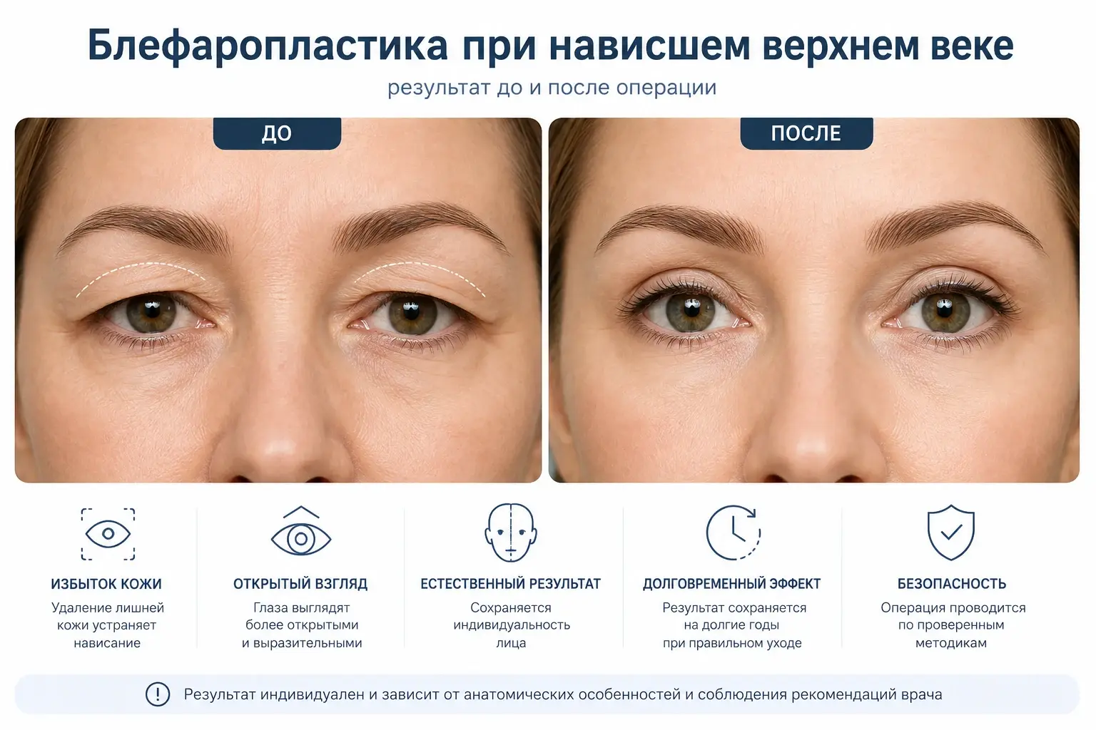 Блефаропластика при нависшем верхнем веке — фото до и после операции