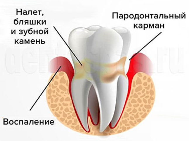 Пародонтит