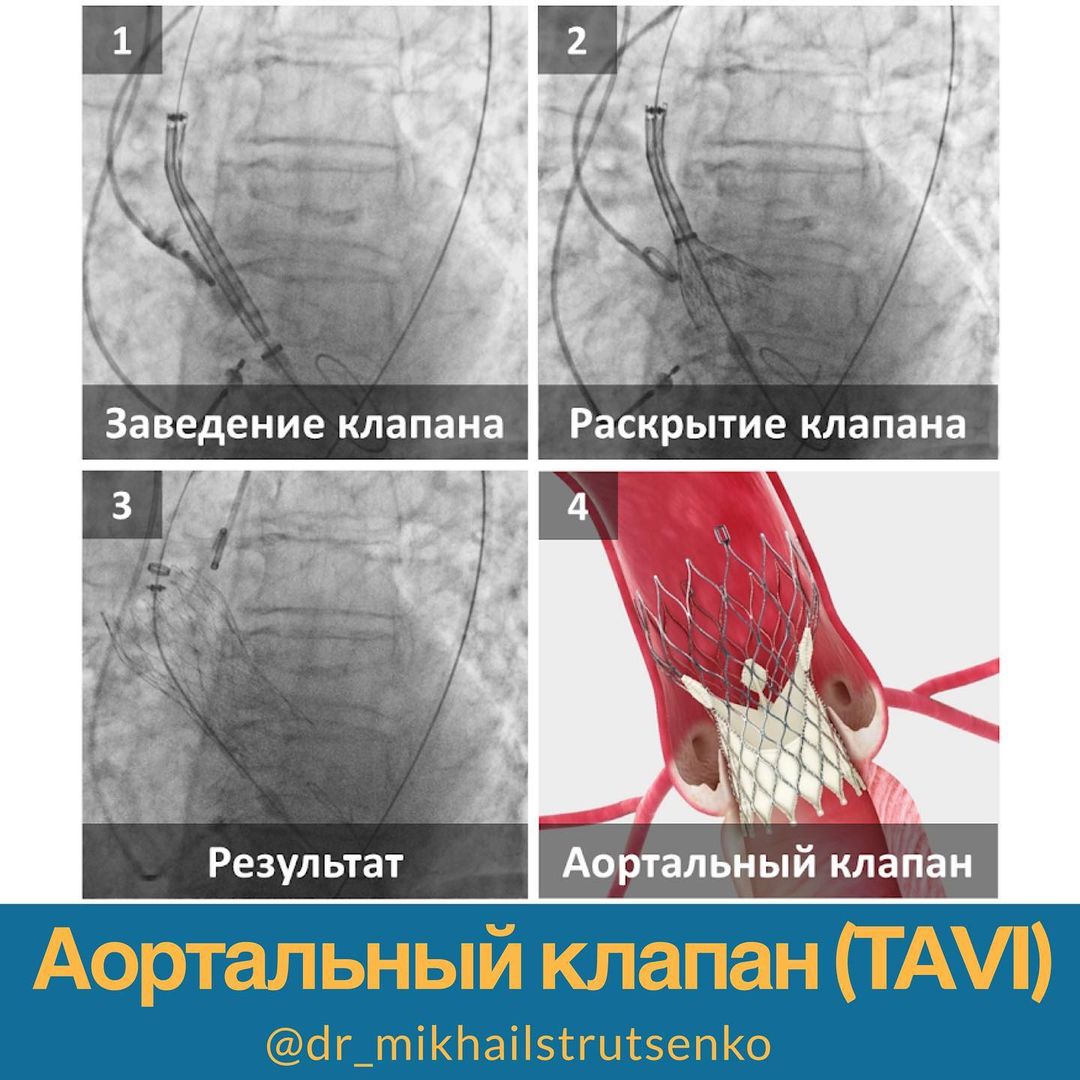 Аортальный клапан (TAVI)