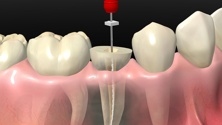 Лечение пульпита — цены и отзывы в Дербенте. Стоматология DK