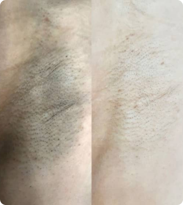 Лазерная эпиляция до после