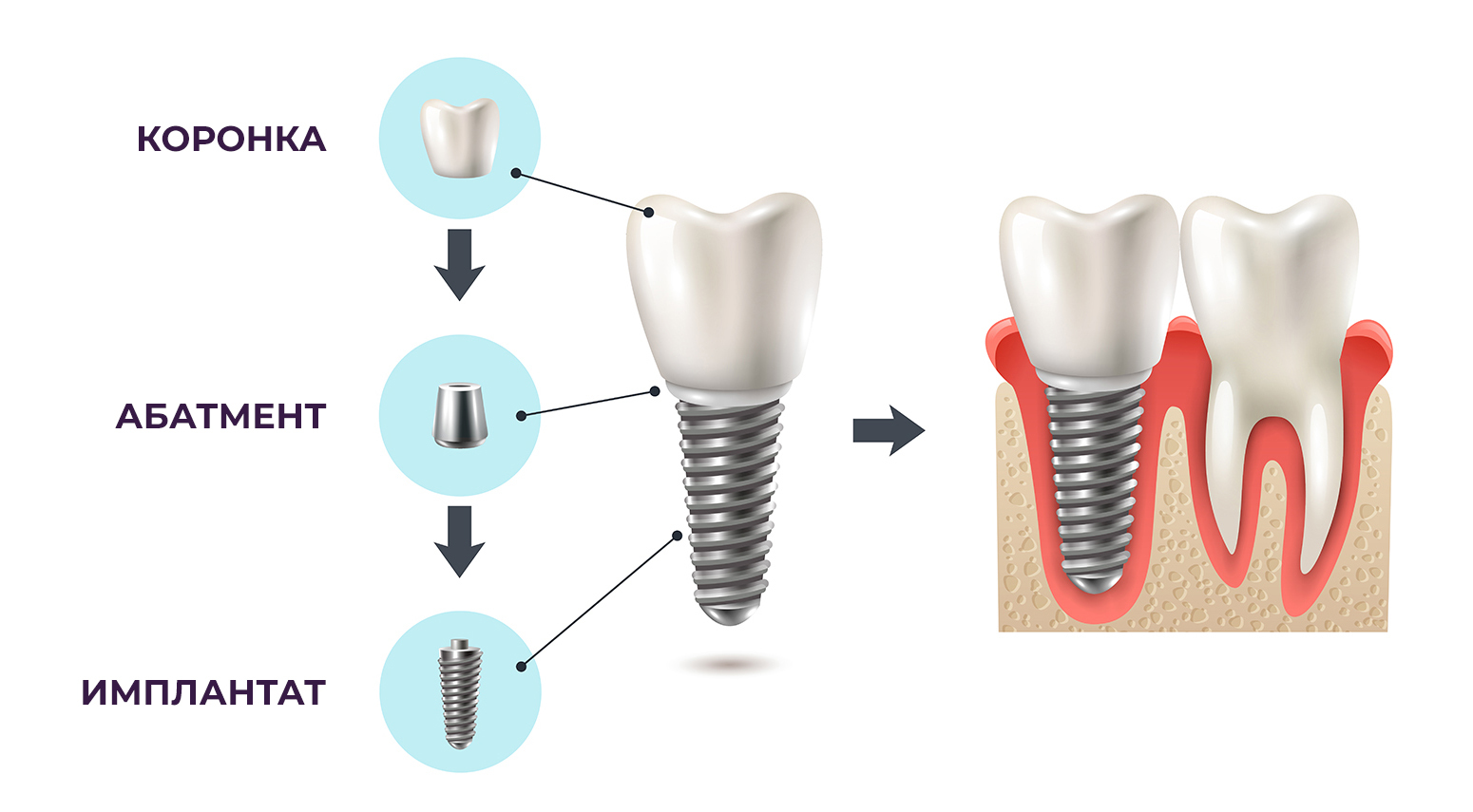 Имплант как ставят зубы пошагово