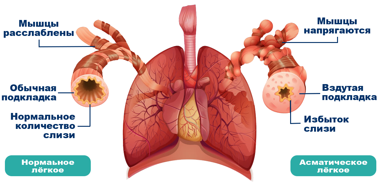 Заболевания дыхательной системы - презентация, доклад, проект скачать