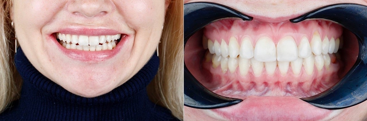 Удлинение (наращивание) зубов — FDC Французская стоматологическая клиника
