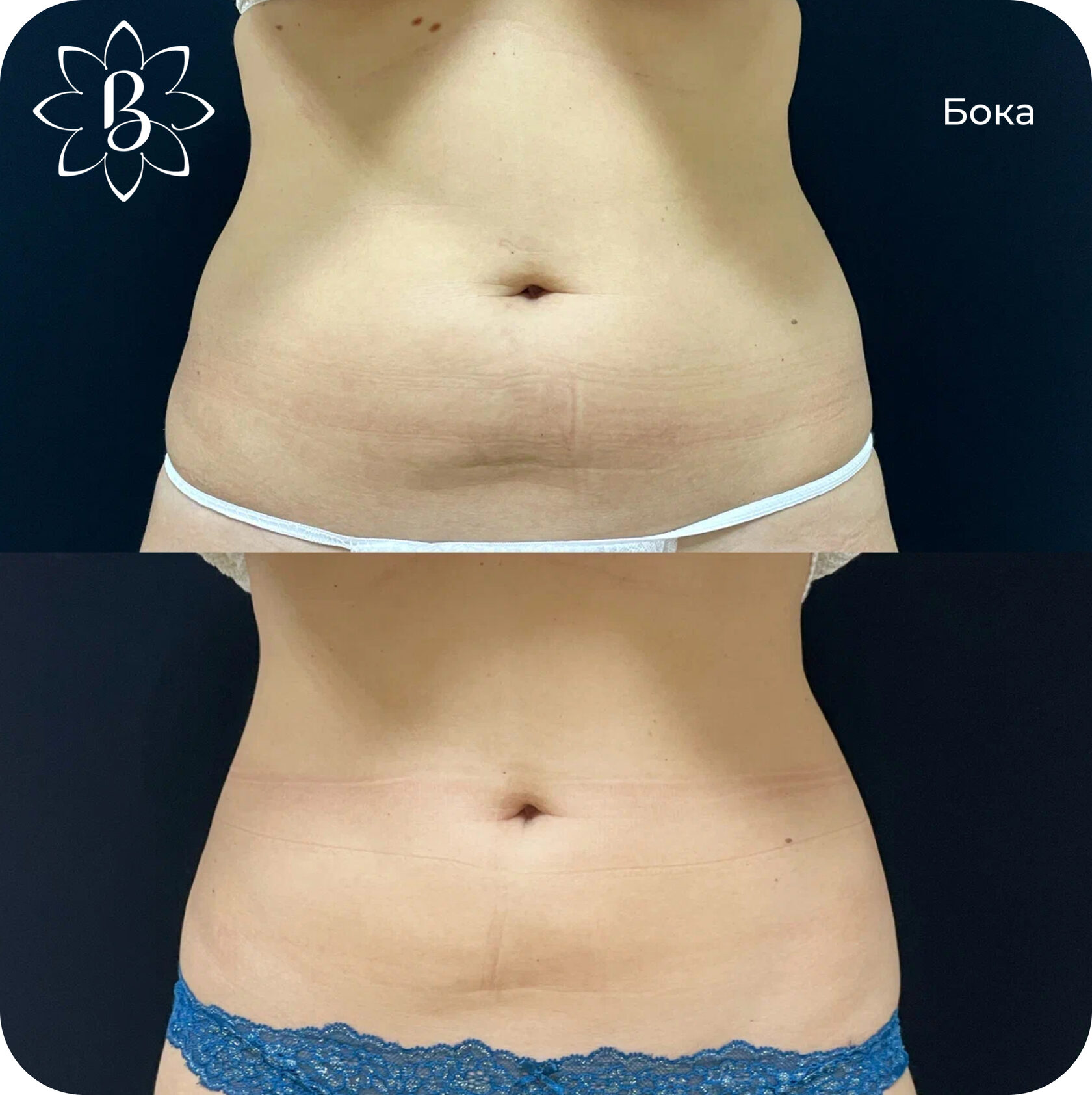 Диодная лазерная эпиляция