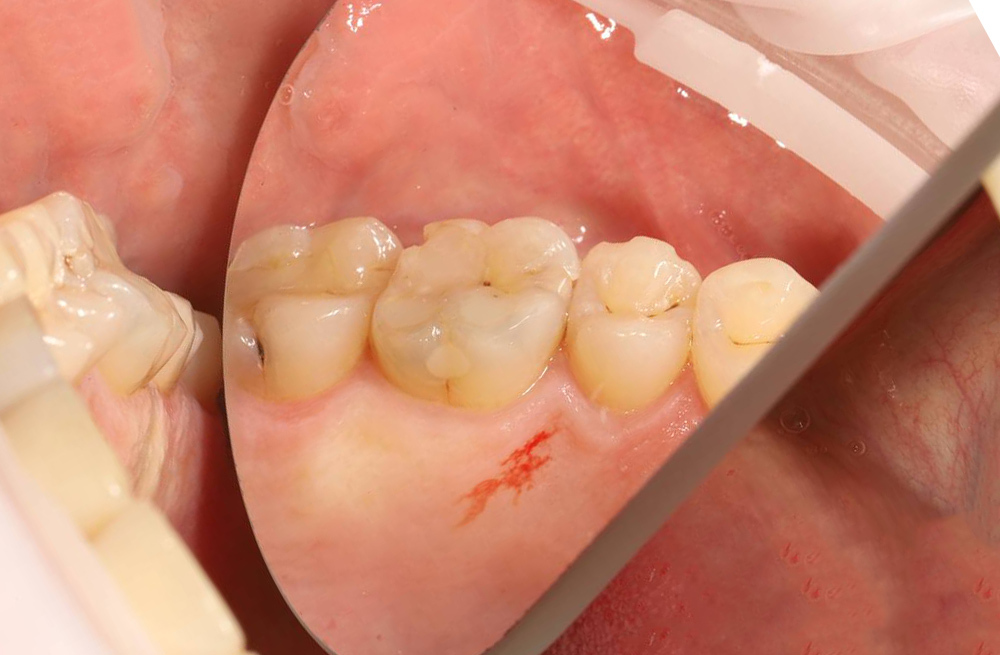 Решение проблемы застревания еды путем лечения кариеса дентина и замены реставрации