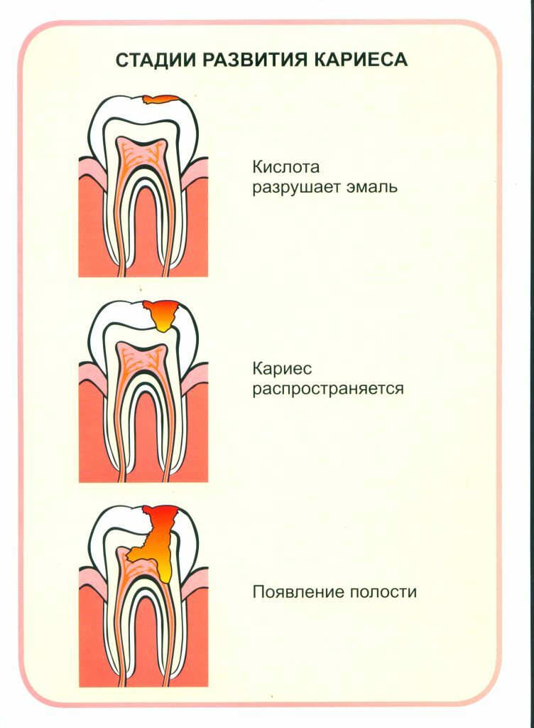 Стадии кариеса. Стадии развития кариеса. Стадии развития кариеса зубов.