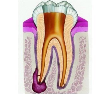 Киста зуба - лечится или нет, как можно вылечить и когда удалять зуб