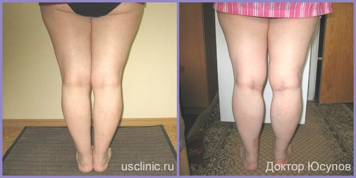 Круропластика - фото до/после