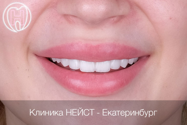 керамические виниры в Екатеринбурге цвет Блич 2 (Bleach 2)