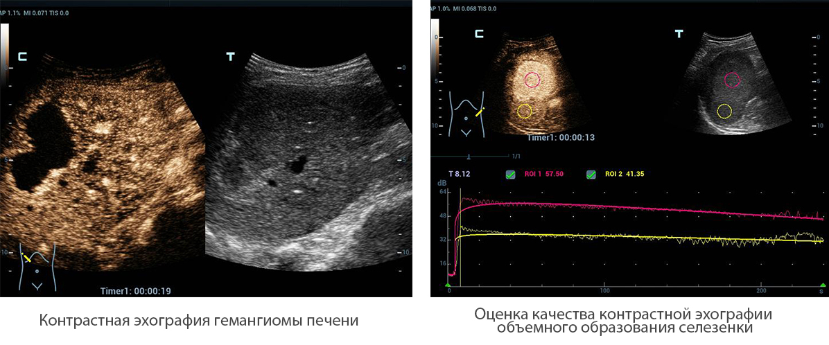 Эхография. Mindray Resona. Контрастная эхография динамическая. Контрастное УЗИ. Эхоконтрастирование в УЗИ.