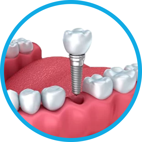 Установка имплантов в Дербенте. Имплантация при отсутствии одного зуба.