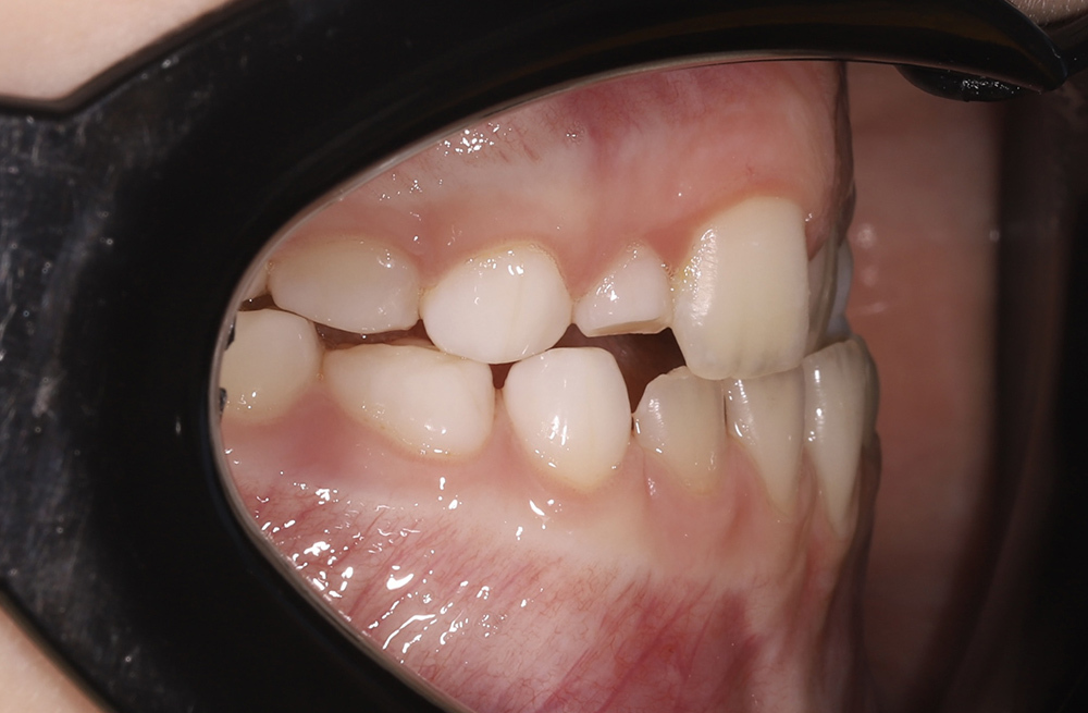 Лечение мезиальной окклюзии и нормализация положения зубных рядов у ребенка