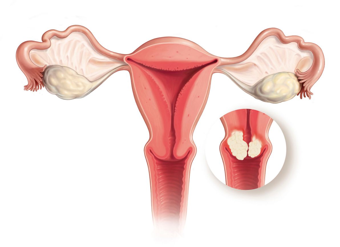 Cervix Pounder