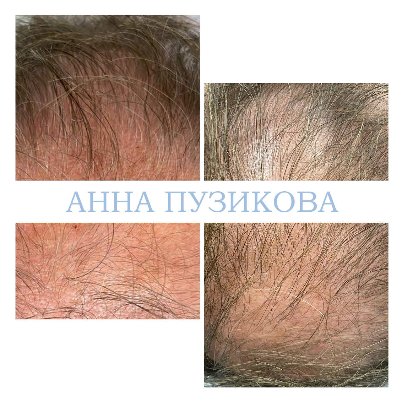 Результат лечения выпадения волос: повышение густоты, укрепление корней и улучшение состояния кожи головы — Прадус СПб.