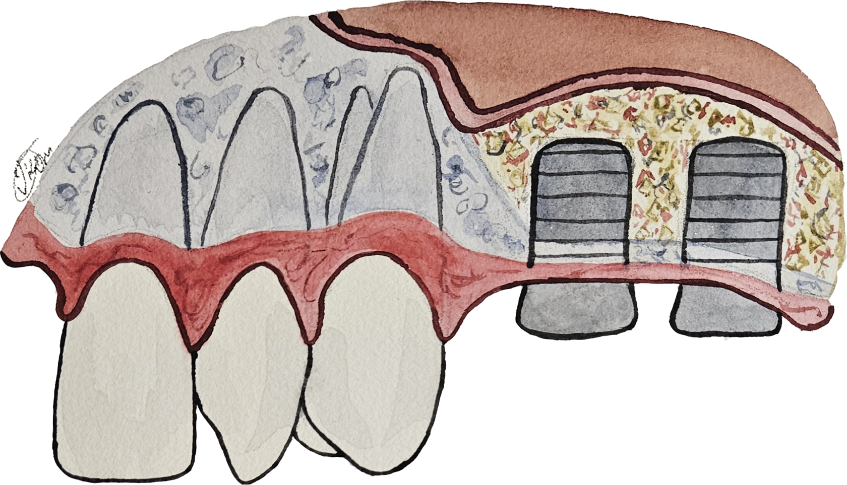 синус лифтинг
