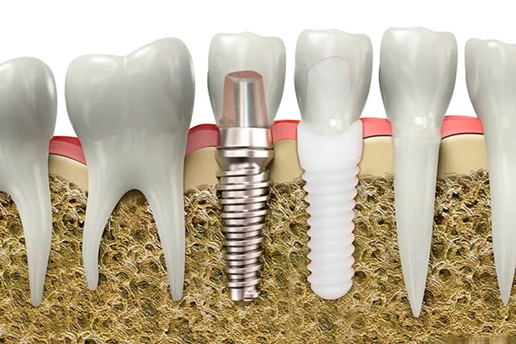 Имплантация зубов в Самаре - Косма - Цена за 1 зуб под ключ