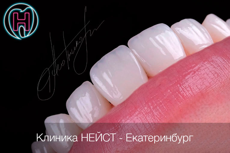 композитные виниры Премиум в Екатеринбурге, цвет Блич 3-4