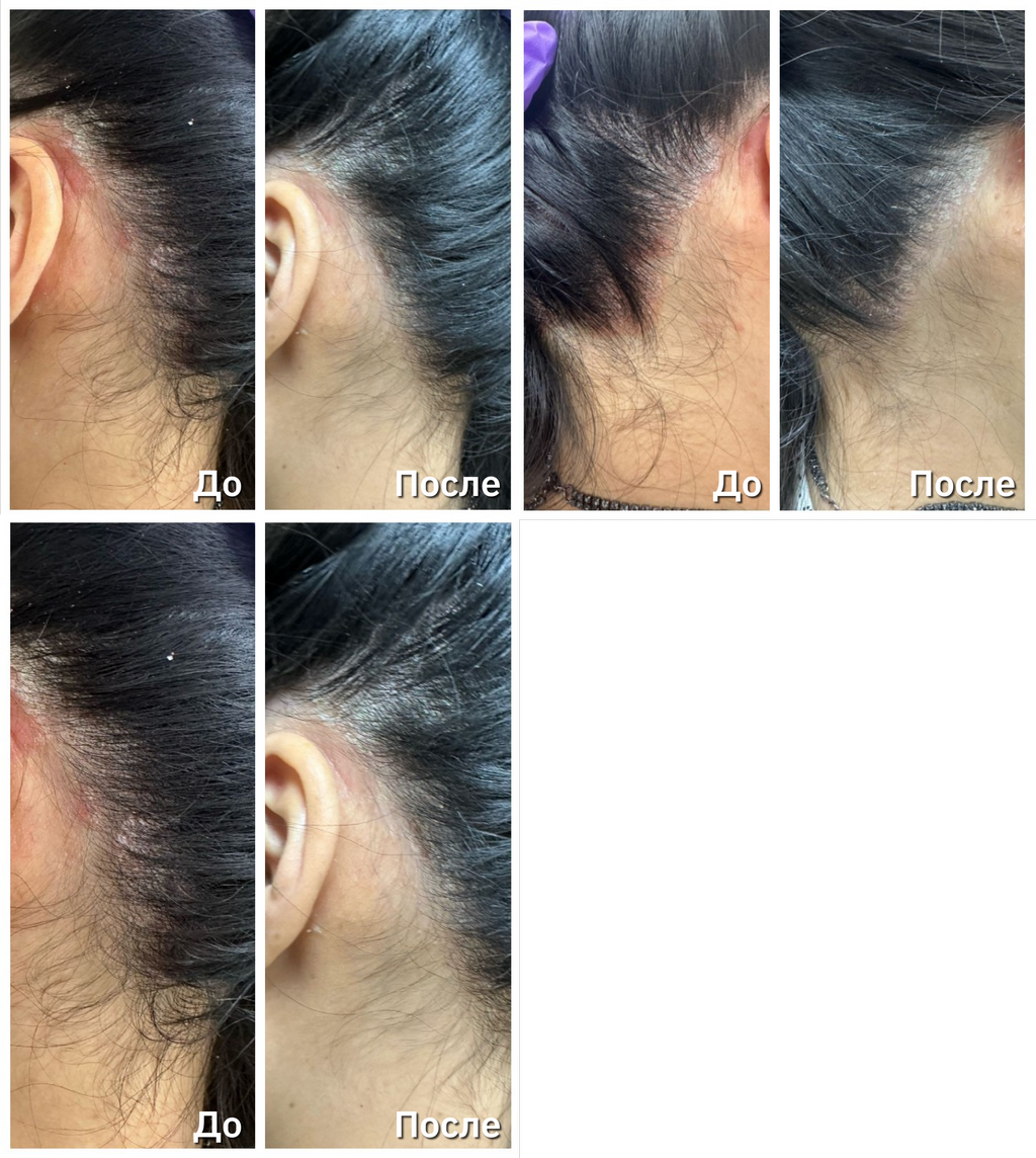 Фотодинамическая терапия REVIXAN - оборудование ФДТ и учебные курсы ...