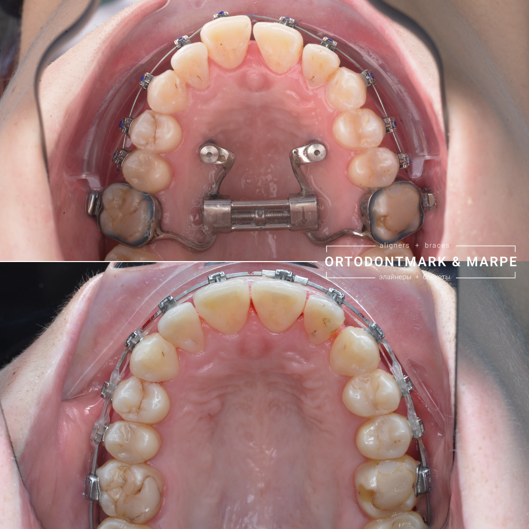 MARPE case result 11