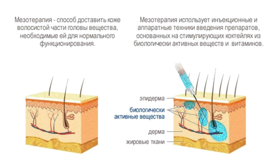 Инъекции головы. Схема мезотерапии волосистой части головы. Схема уколов мезотерапии в голову. Техника введения мезотерапии в кожу головы. Мезотерапия кожи головы схема лечения.