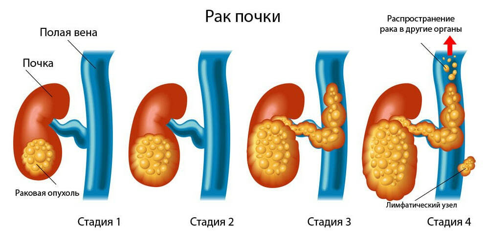 Болезнь почек у кошек симптомы и лечение